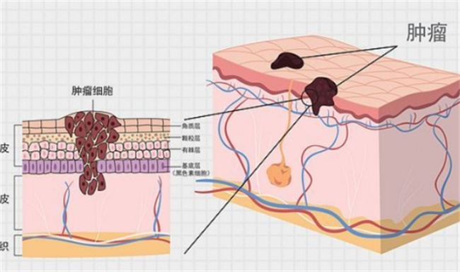 如何分辨黑色素瘤和普通痣 二者哪个更严重