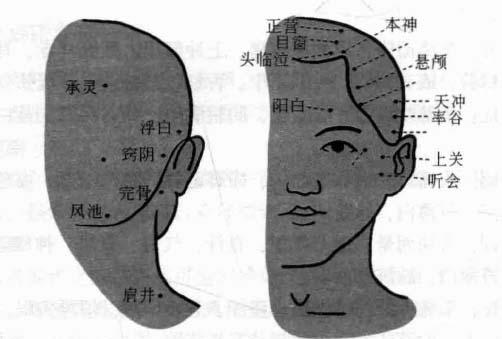 偏头痛磁圆梅针疗法