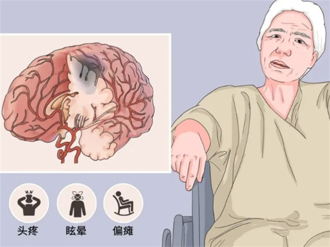 30岁男子3年3次中风 为什么会这样?