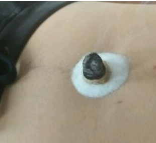 隔矾灸