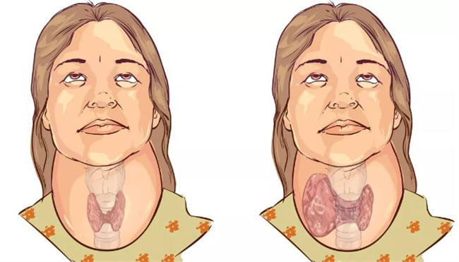甲状腺肿大可以吃海盐吗 甲状腺肿大可以吃海参吗