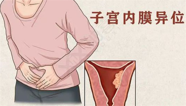 子宫内膜异位症怎么检查 子宫内膜异位有什么症状